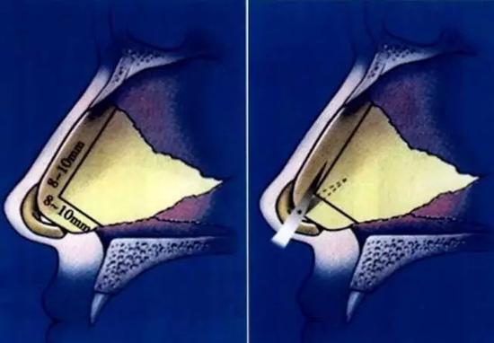 鼻中隔软骨取材范围