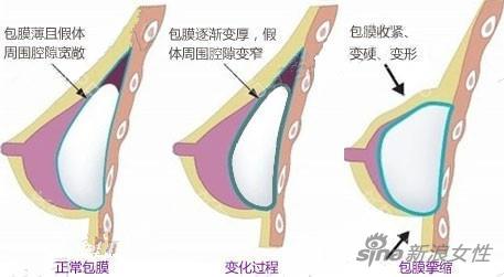 包膜挛缩