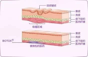 Botox作用原理