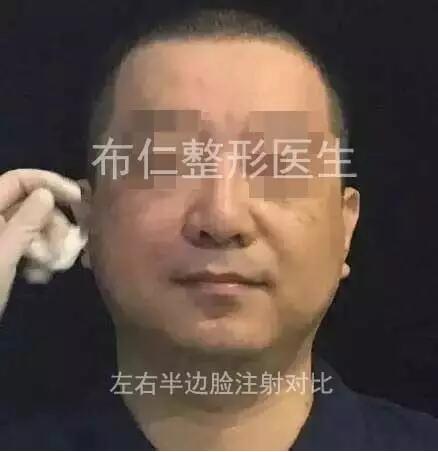 消除法令纹