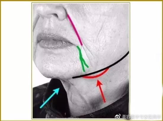 【涨点姿势】面部提升与面部除皱整形|软组织