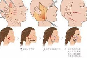 自体脂肪填充脸后可以吃安眠药吗？