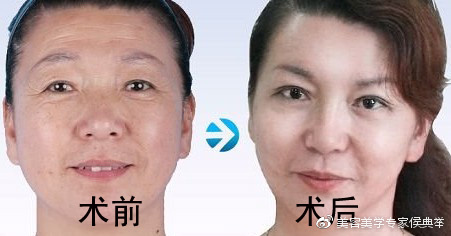 无创除皱,还您年轻容貌|除皱术|皱纹|求美者