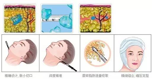 面部吸脂