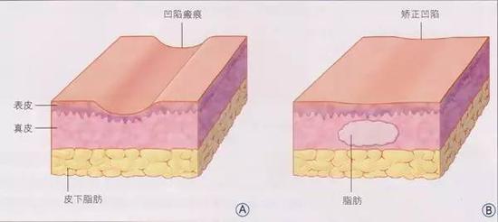 脂肪填充