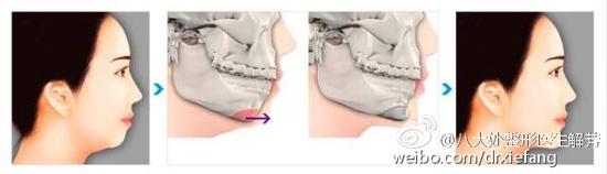 下颏截骨前置垫下巴