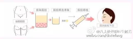 自体脂肪移植垫下巴