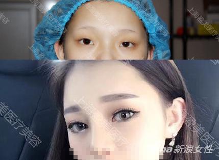 上海盈美整形机构案例