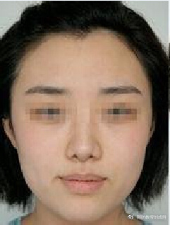 凹陷