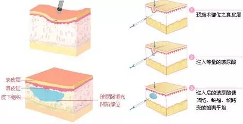 玻尿酸的原理是什么_玻尿酸的原理