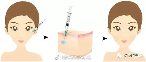 收缩毛孔?激光or水光针哪一个更好?|护肤品|毛