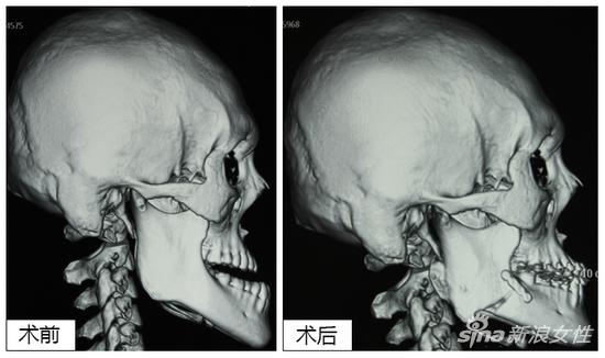 X光片对比