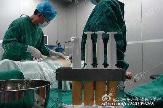 做全身吸脂手术过程时疼不疼?