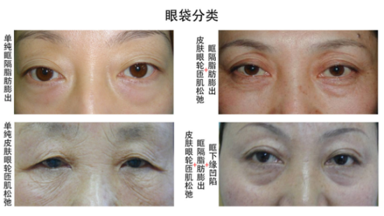 比起林小宅炸裂的苹果肌,快手李圣经眼袋更突