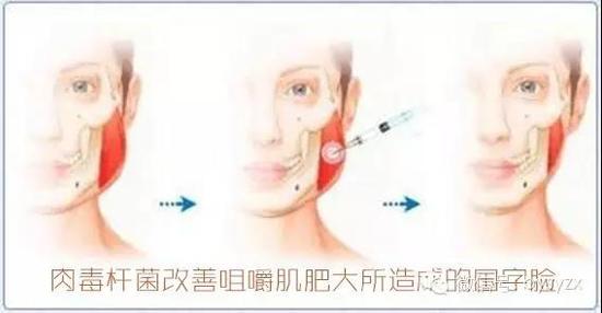 面部肥胖自测小方法