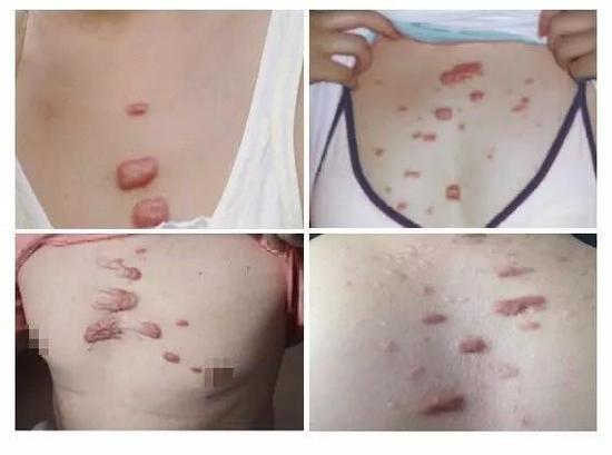 小小毛囊炎也会变变变!