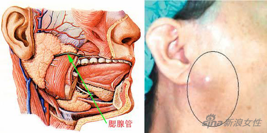 腮腺或腮腺导管损伤