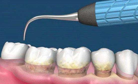 如何去除牙结石?洗牙去牙结石并非一劳永逸|家