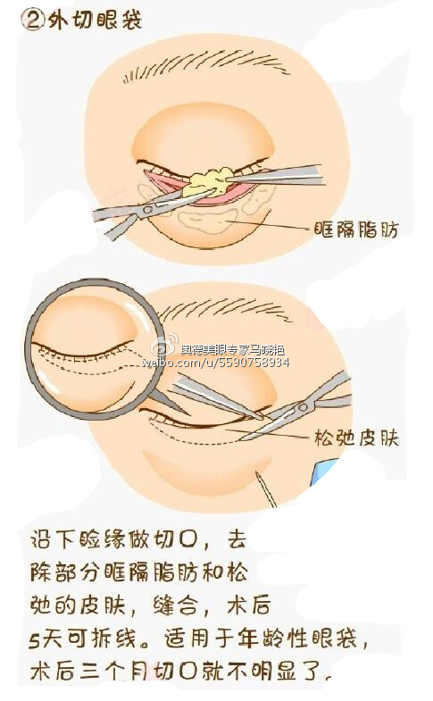 外切眼袋