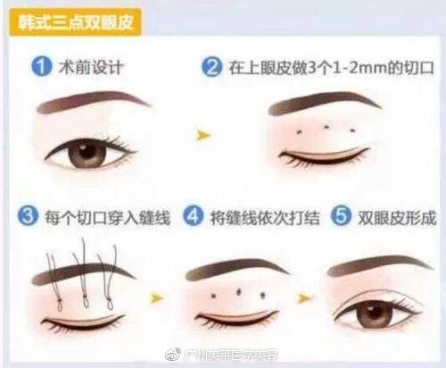 埋线、三点、切开,双眼皮手术怎么选?|双眼皮手