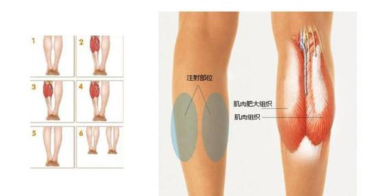 打瘦腿针存在着哪些副作用?