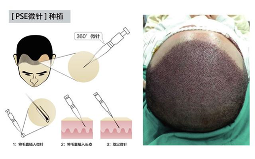 PSE微针种植