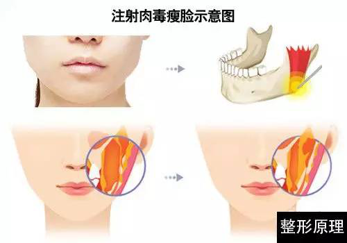 10个人打瘦脸针有8个说脸凹陷?瘦脸针到底能