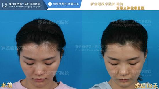 案例二:低头45°