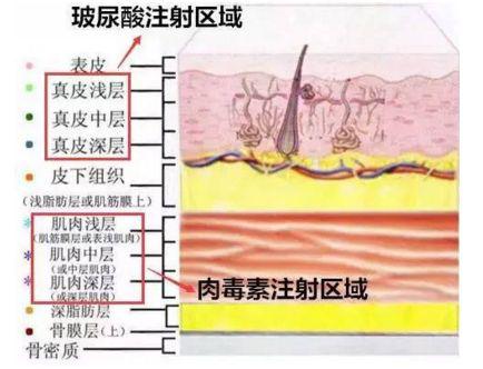 玻尿酸注射区域