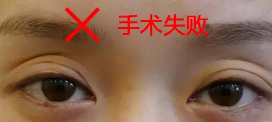 割双眼皮后出现三眼皮怎么办