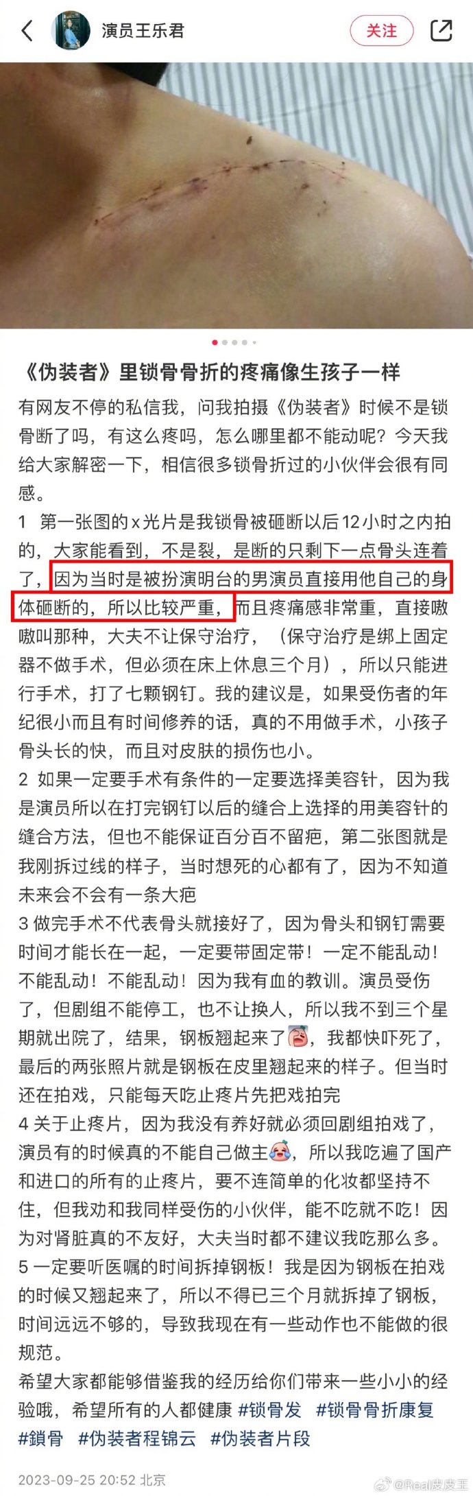 王乐君发文称《伪装者》拍摄期间被胡歌砸断了锁骨