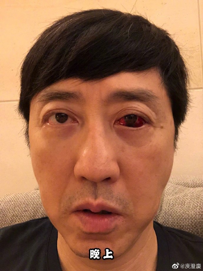 组图:慎点!庾澄庆晒照白眼球布满血块 幽默自侃"火眼金睛"