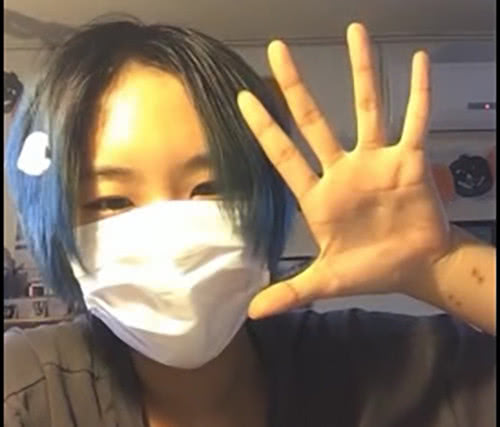 窦佳媛手腕疤痕