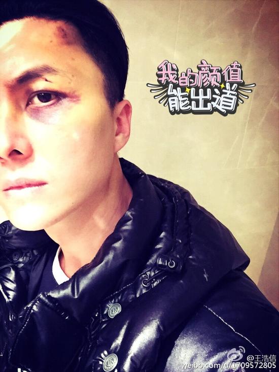 王浩信受伤明显