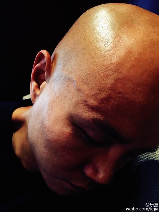 乐嘉到拉萨高原反应强烈