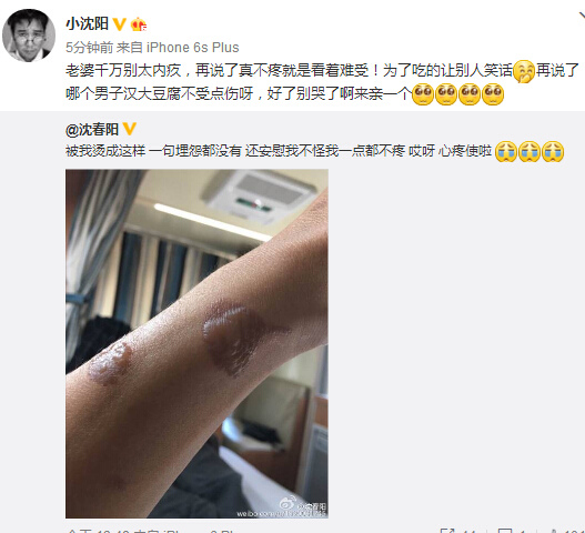 小沈阳被爱妻烫伤手臂起包