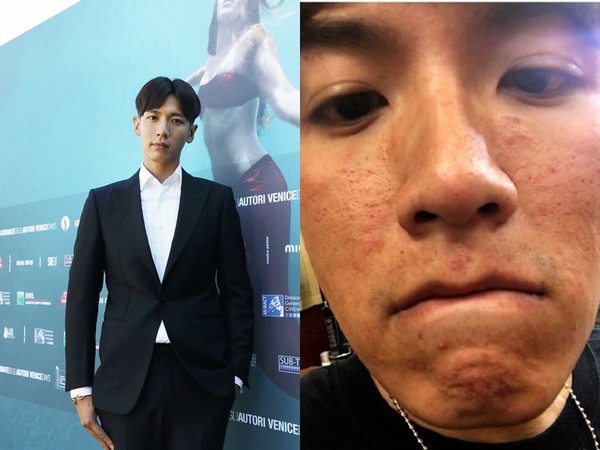 海鲜过敏脸肿_蒋勤勤皮肤过敏红又肿过敏季肌肤如何平安渡劫
