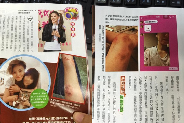 昆凌前助理安琪出示伤照(右),F小姐也控诉遭她打到瘀青(左)
