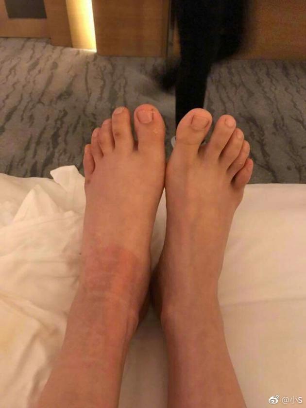 小s录影扑街左脚肿胀 网友:全程看你的胖脚