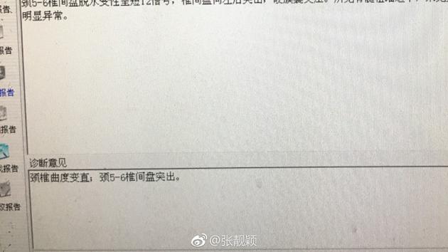 张靓颖腰椎间盘突出