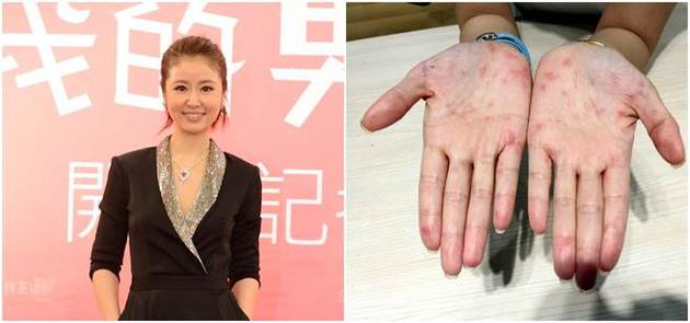 林心如患“玫瑰糠疹”