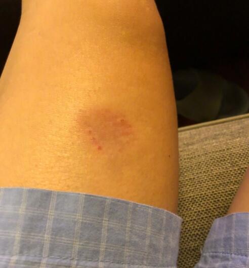 遭家暴?张智霖晒大腿伤痕 网友的关注点却在这