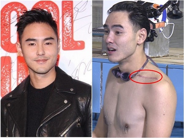 阮经天2015年曾骑车摔伤，在综艺节目上露出锁骨长条疤痕。