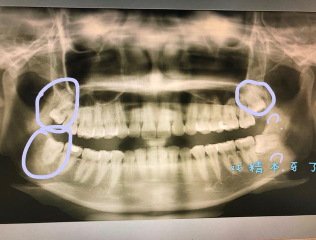 吴宣仪晒照自曝将拔智齿 调侃自己的牙是戏精