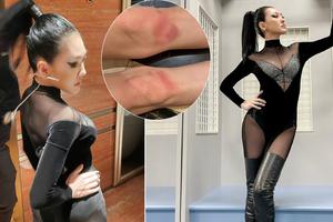 小S为蔡依林演唱会练舞膝盖红肿