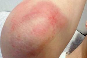 范丞丞拍《左肩有你》受伤 手臂布满淤青