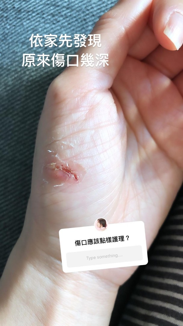 唐诗咏在社交网站晒出受伤照