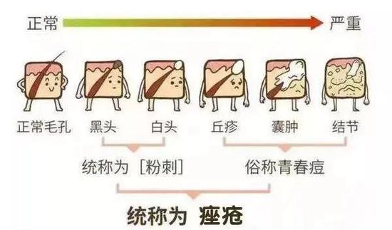 【美气子】专家坐堂解答：痘痘闭口黑头总是不见好的肌肤疑惑