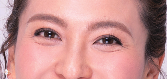 眼带怎么消,眼带怎么消除