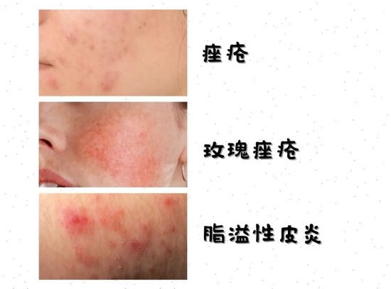 为什么嘴巴周围老是长痘痘?